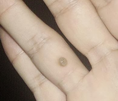 ¿qué es una verruga en el dedo